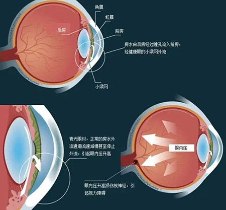 三种情况小心青光眼